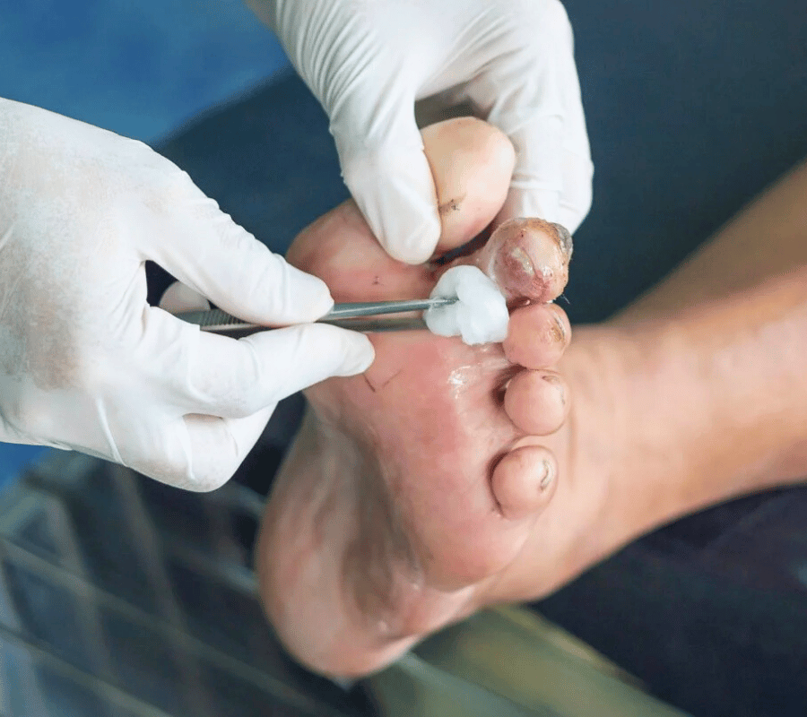 Who Needs Debridement Services