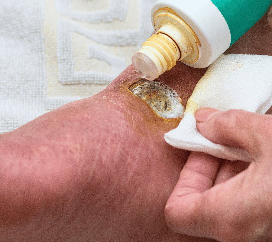 Who Needs Diabetic Foot Ulcer Management?