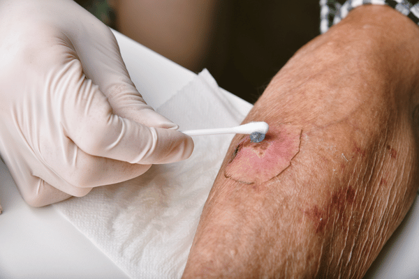 Wound Assessment Photo