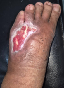 Photo of healing process