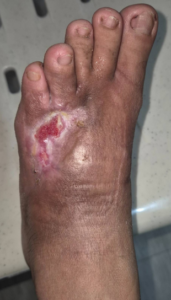 Photo of healing process