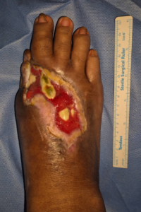 During Healing Process