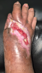 During Healing Process