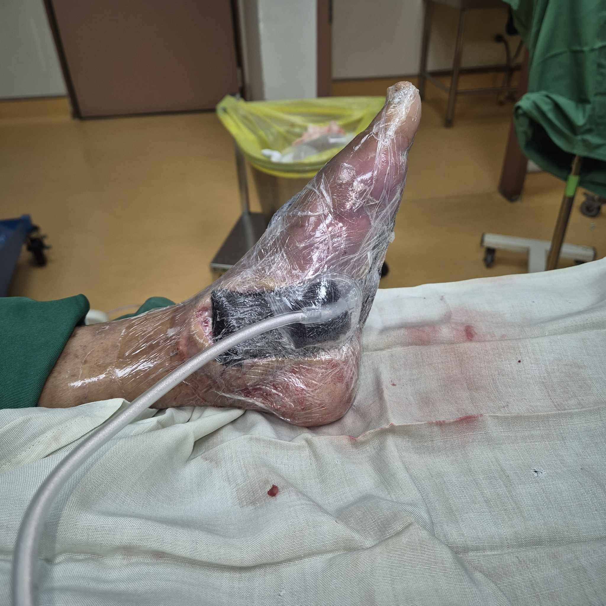 Photo of Pressure Ulcer Treatment