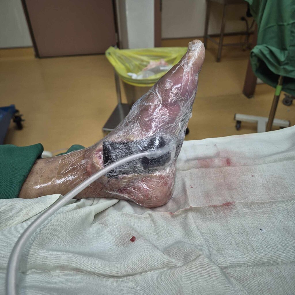 Photo of Advanced Negative Pressure Wound Therapy