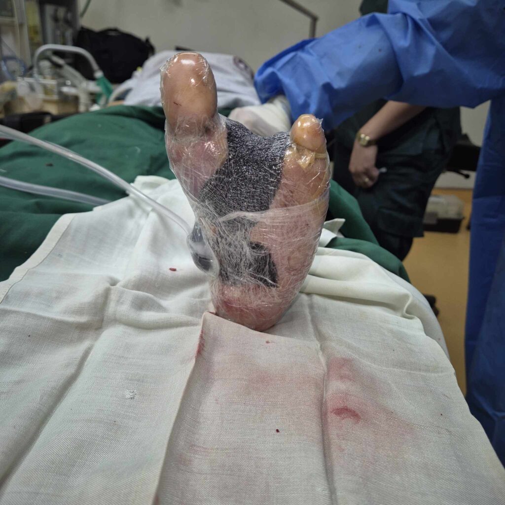 Photo of Negative Pressure Wound Therapy