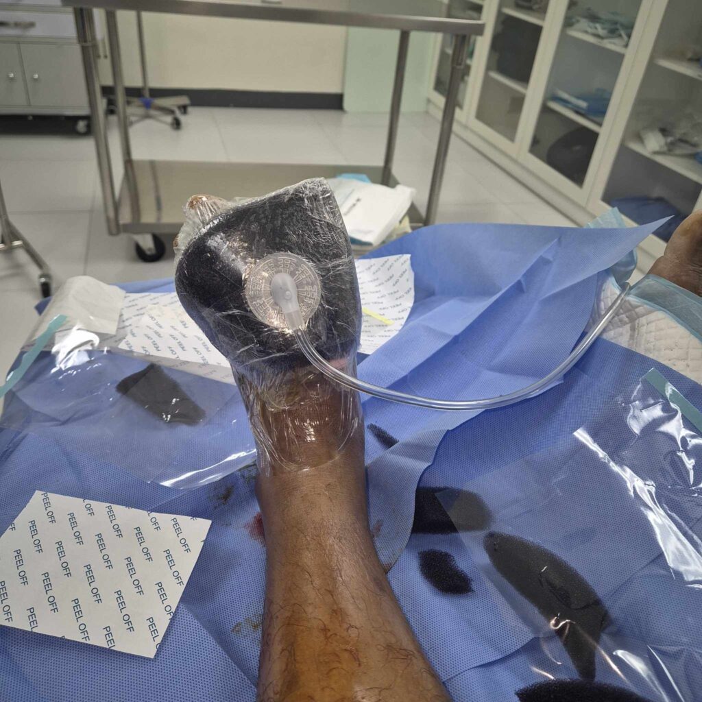 Negative Pressure Wound Therapy Photo