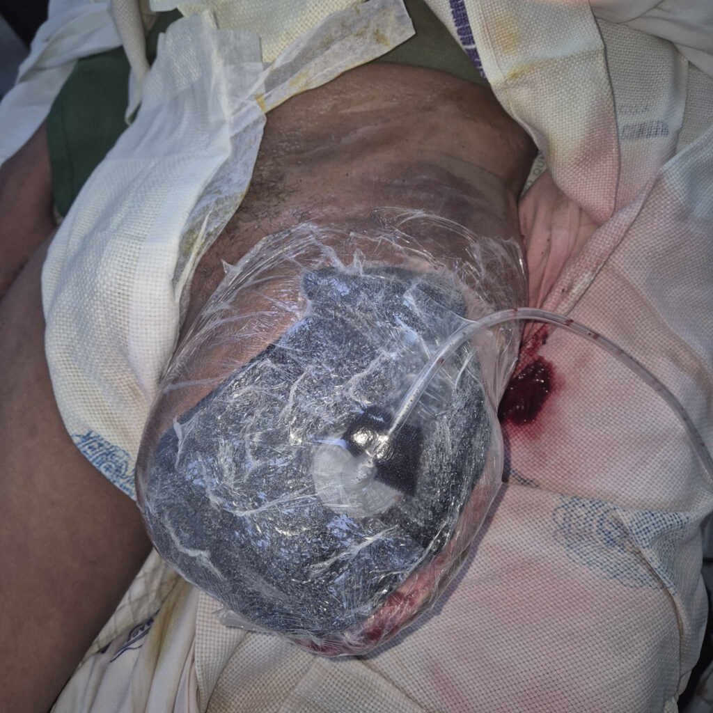 Negative Pressure Wound Therapy Image