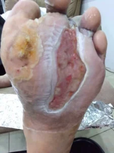 Photo of the healing process