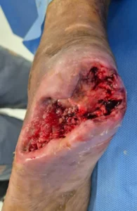 photo of the healing process