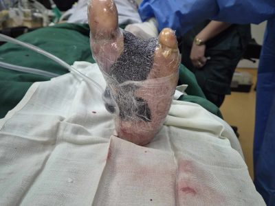 Photo of Negative Pressure Wound Therapy