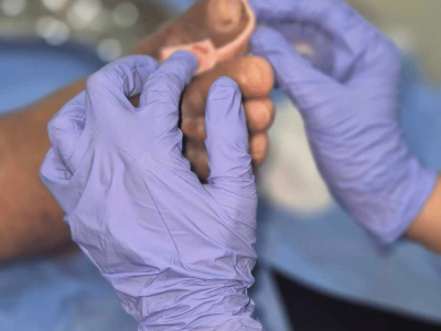 Venous Insufficiency Ulcer Care Photo